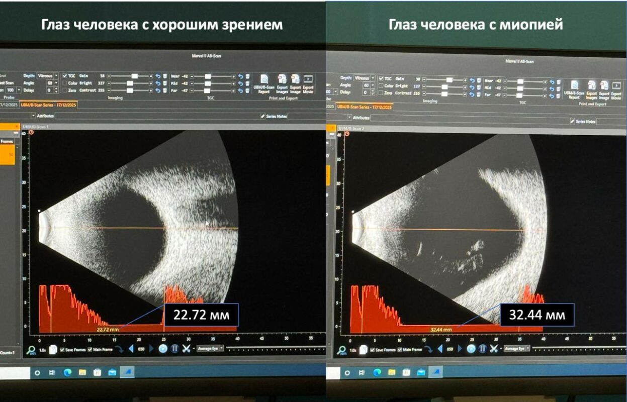 В Вологде прооперировали пациента с рекордно высокой степенью близорукости