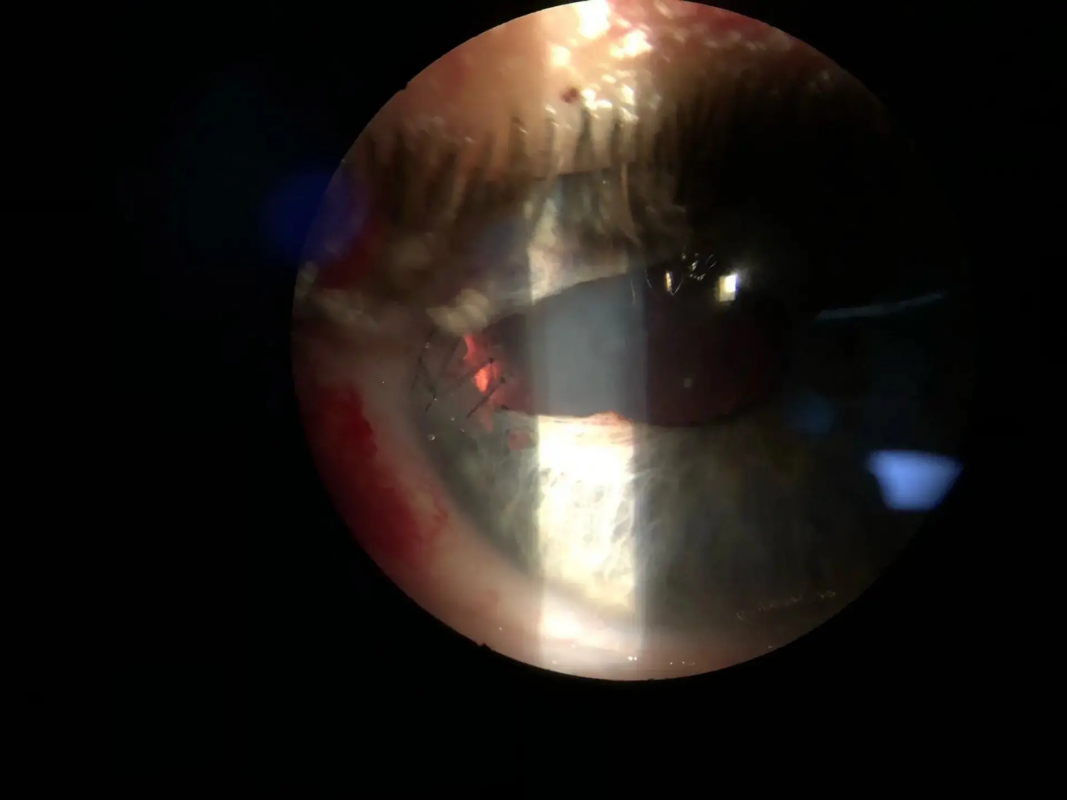 Вологодские врачи спасли зрение жителю Белоруссии после ДТП