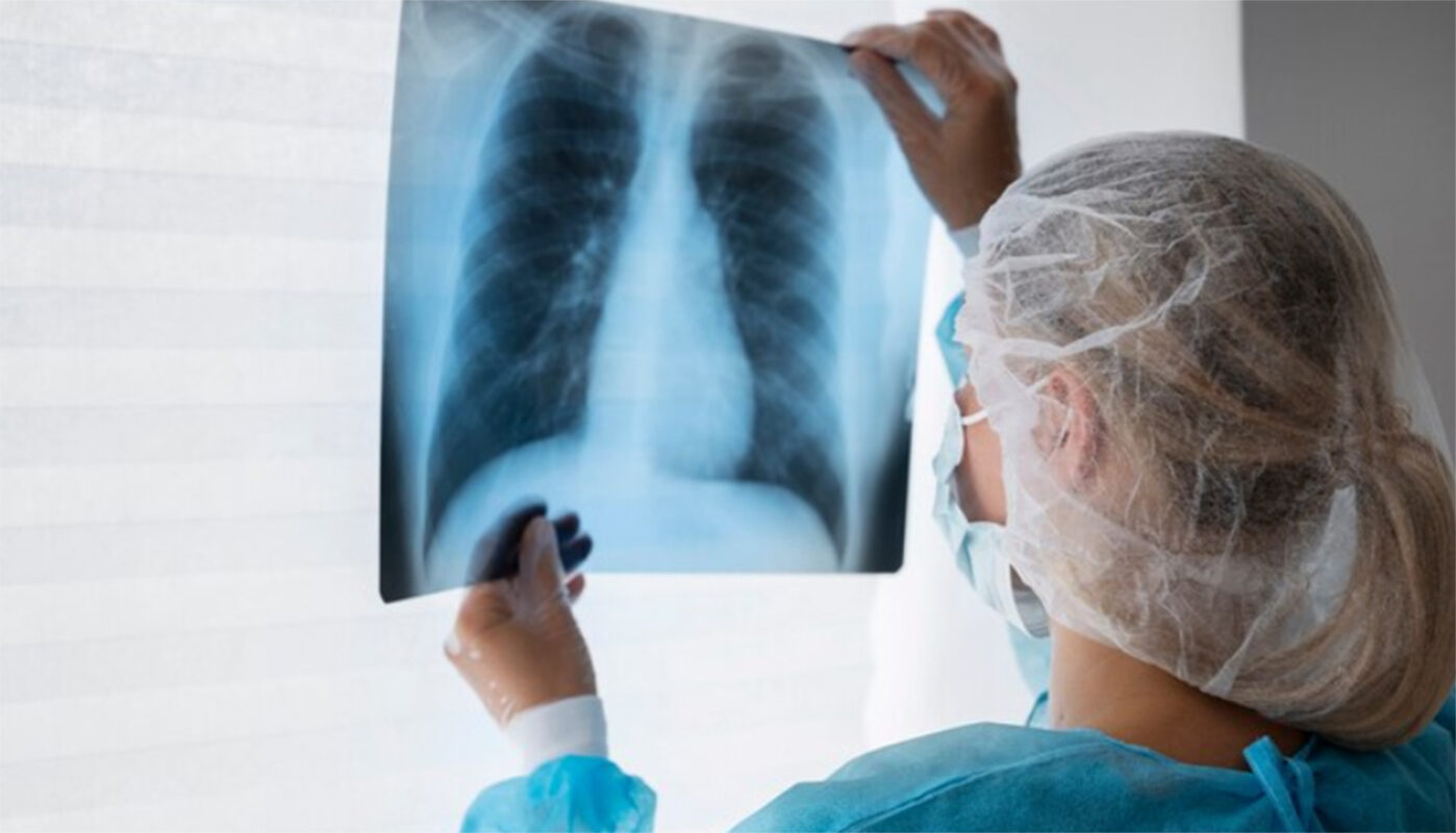 Благодаря диспансеризации у жителя Череповца вовремя выявили рак легкого